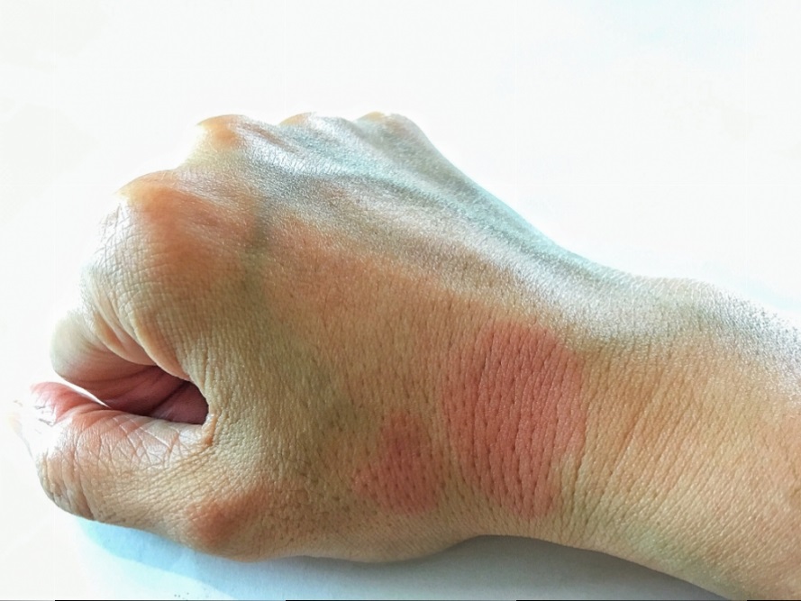 Lúpus: Uma doença sem cura, mas que pode ser tratada