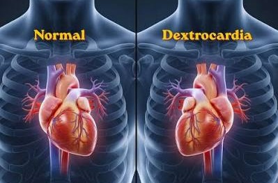 Dextrocardia: Apenas 1% da população mundial possui o coração no lado direito do tórax