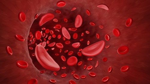 Anemia Falciforme, alteração genética e hereditária dos glóbulos vermelhos do sangue