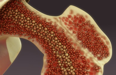 Doação de medula óssea: esperança de cura para doenças sanguíneas